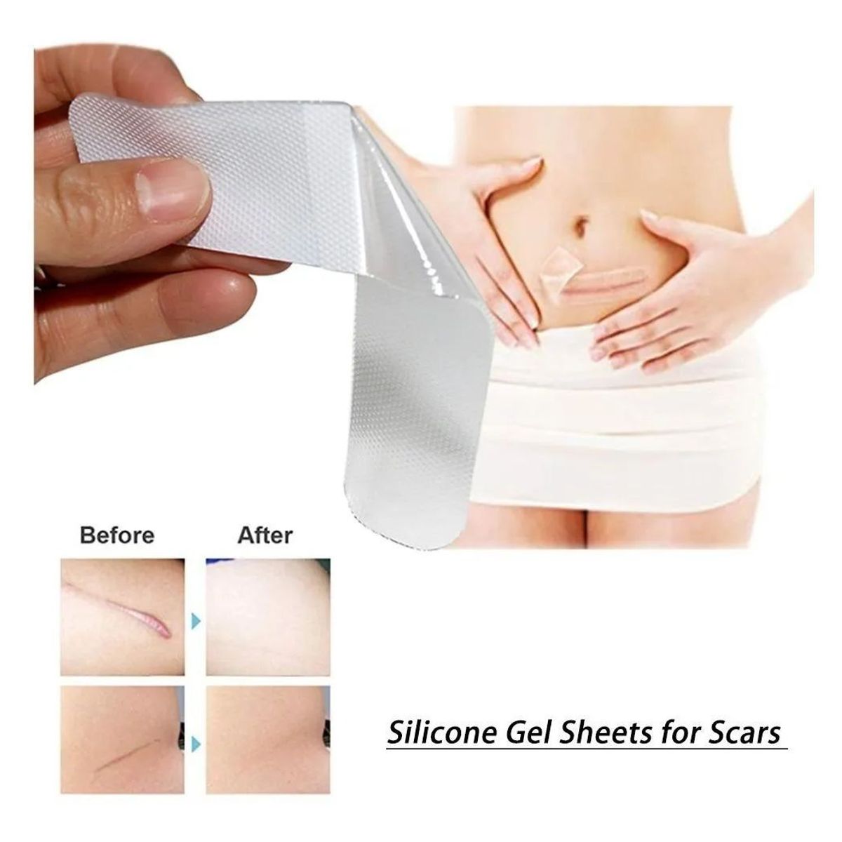 KUANGYE - Parche De Silicona Para Cicatrices Hipetróficas Y Queloides
