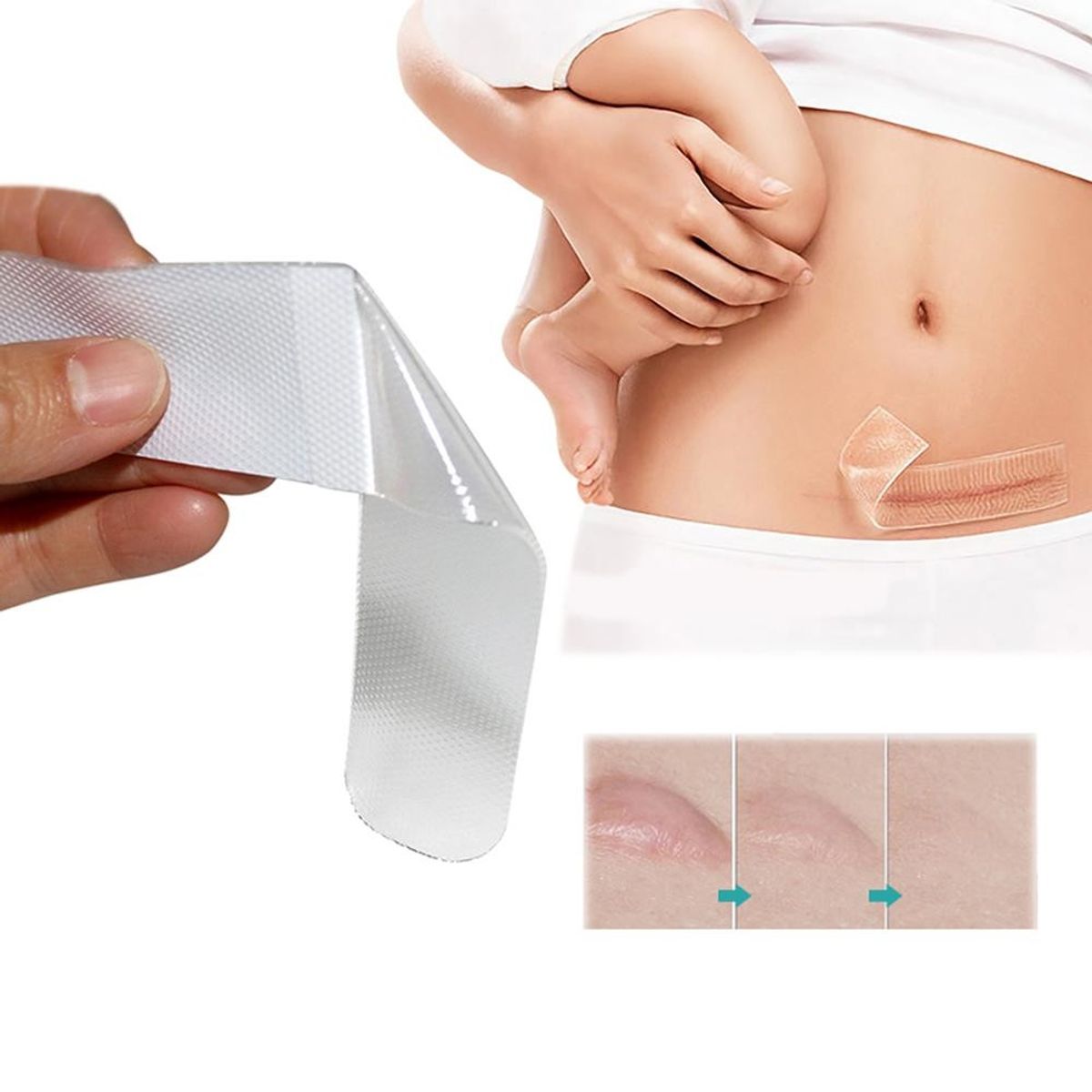KUANGYE - Parche De Silicona Para Cicatrices Hipetróficas Y Queloides