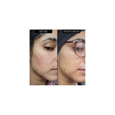 Imagen 2 del producto Serum de Azelaico al 10% 30ml -THE INKEY LIST