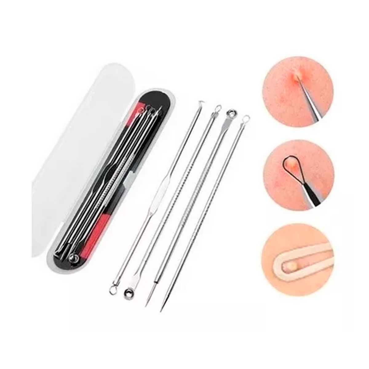 GENERICO - Set 4 Removedor De Puntos Negros Espinillas