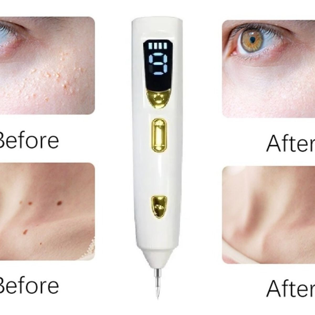 GENERICO - Plasmapen 9 Potencias Lápiz Removedor De Verrugas Lunares Recargable