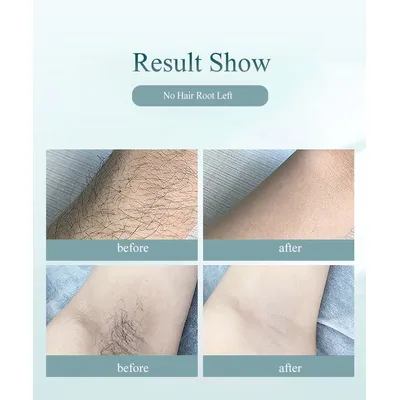 Imagen 2 del producto Depiladora IPL 900000 láser Depiladora Profesional Permanente Blanco