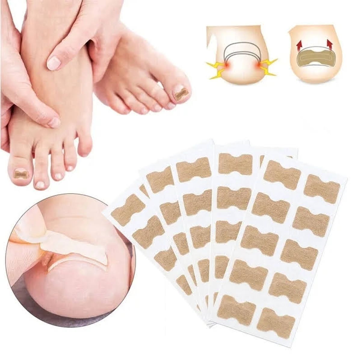 GENERICO - Pack x30 Parches Para Corregir Uña Encarnada Corrector Pie