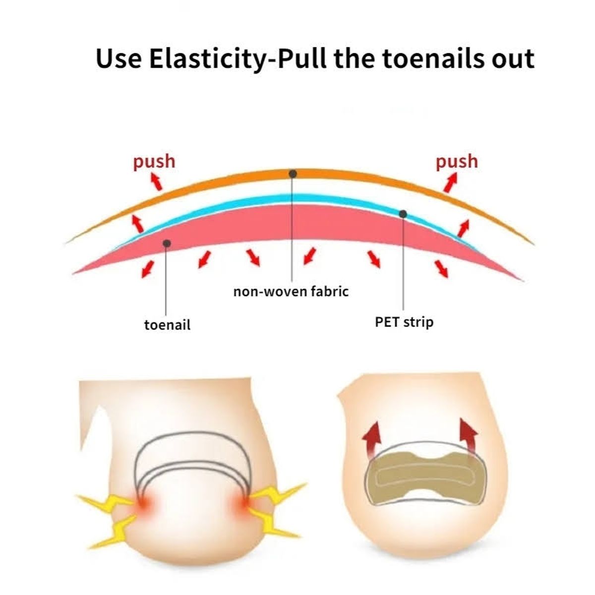 GENERICO - Pack x30 Parches Para Corregir Uña Encarnada Corrector Pie