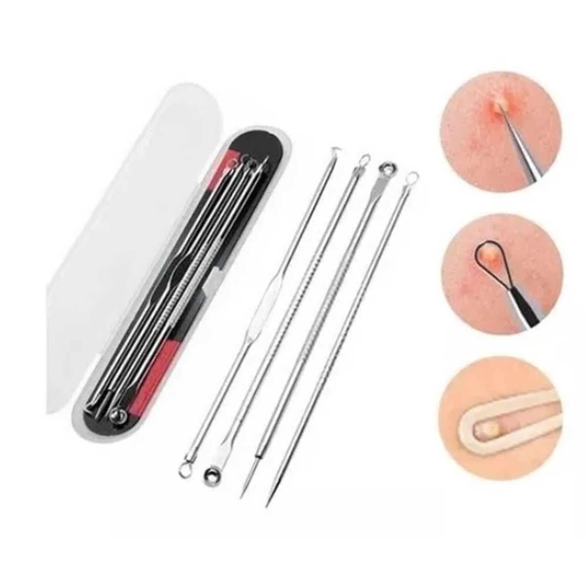 GENERICO - Set 4 Removedor Extractor Comedones Puntos Negros Espinillas