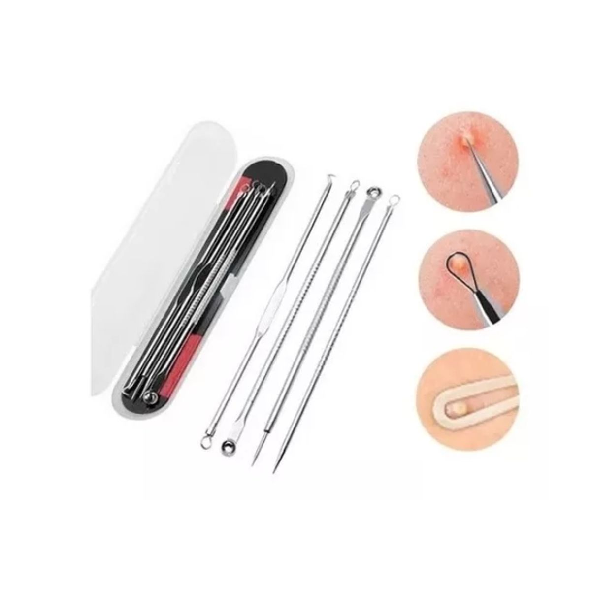 GENERICO - Set 4 Removedor Extractor Comedones Puntos Negros Espinillas