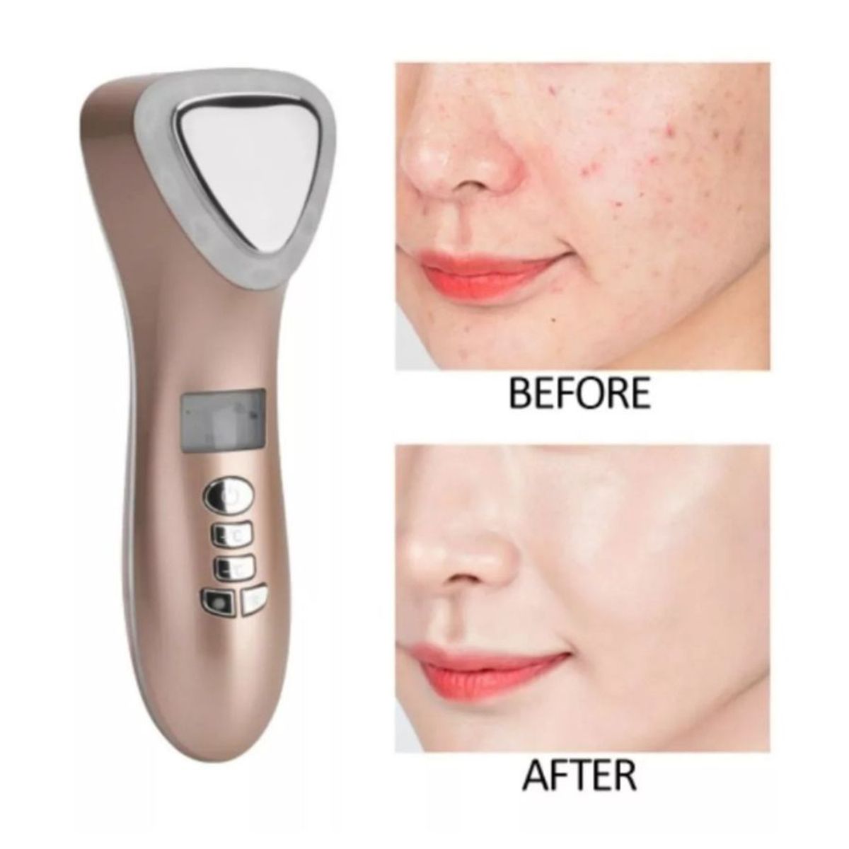 GENERICO - Maquina Crioterapia Ultrasónica Limpiador Facial FrioCalor