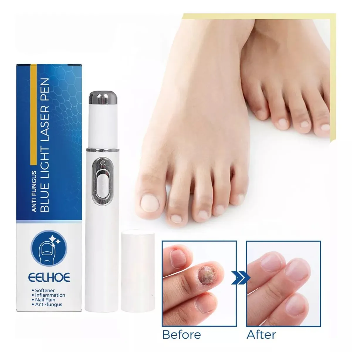 KUANGYE - Lápiz Láser Reparador De Uñas Para Onicomicosis Con Láser