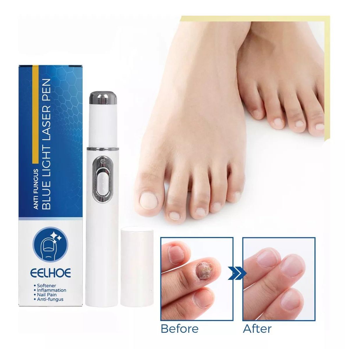 KUANGYE - Lápiz Láser Reparador De Uñas Para Onicomicosis Con Láser