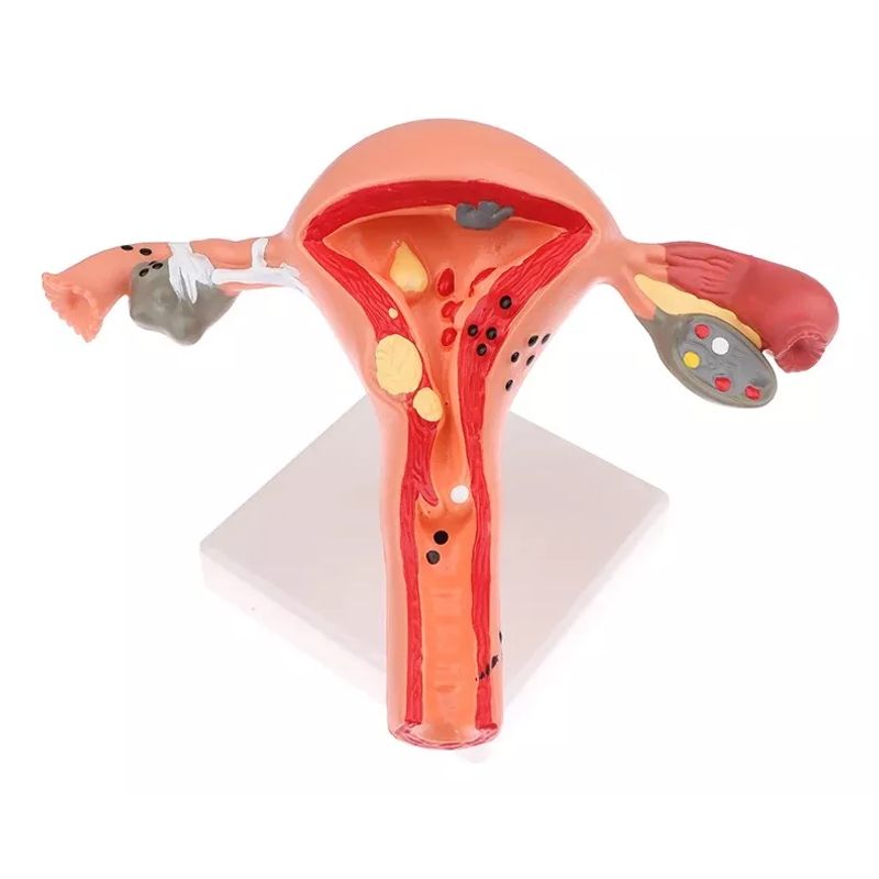 GENERICO - Modelo Anatómico De Útero 17cm Con Patologías Incluye Base