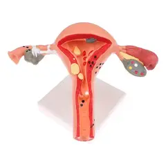GENERICO - Modelo Anatómico De Útero 17cm Con Patologías Incluye Base