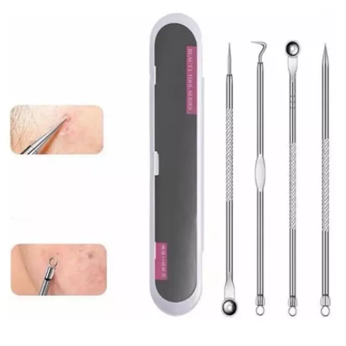 GENERICO - 12 X Kit Extractores Puntos Negros