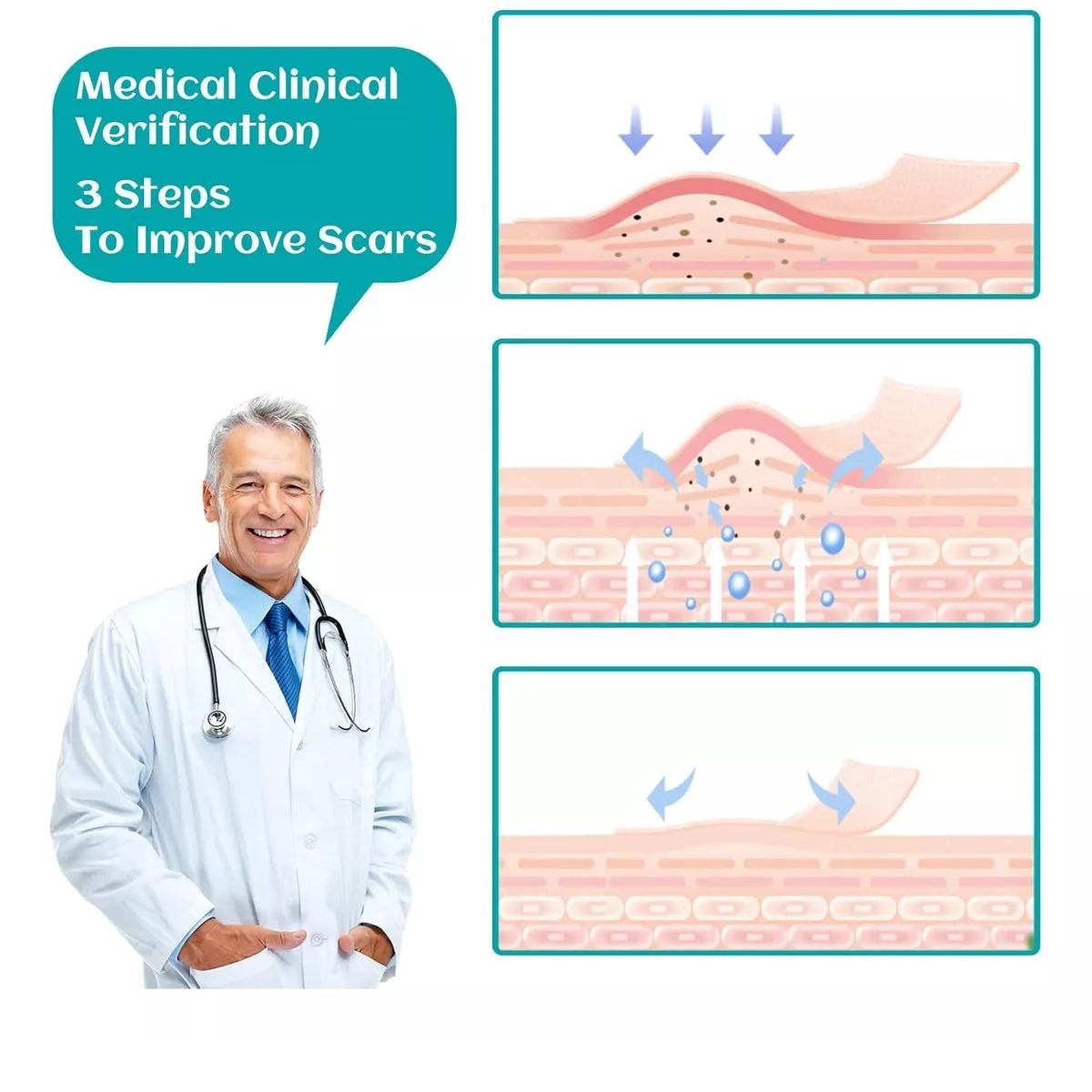 GENERICO - Parche Para Cicatrices Queloides Gel Rollo De 4cmx1m Heridas