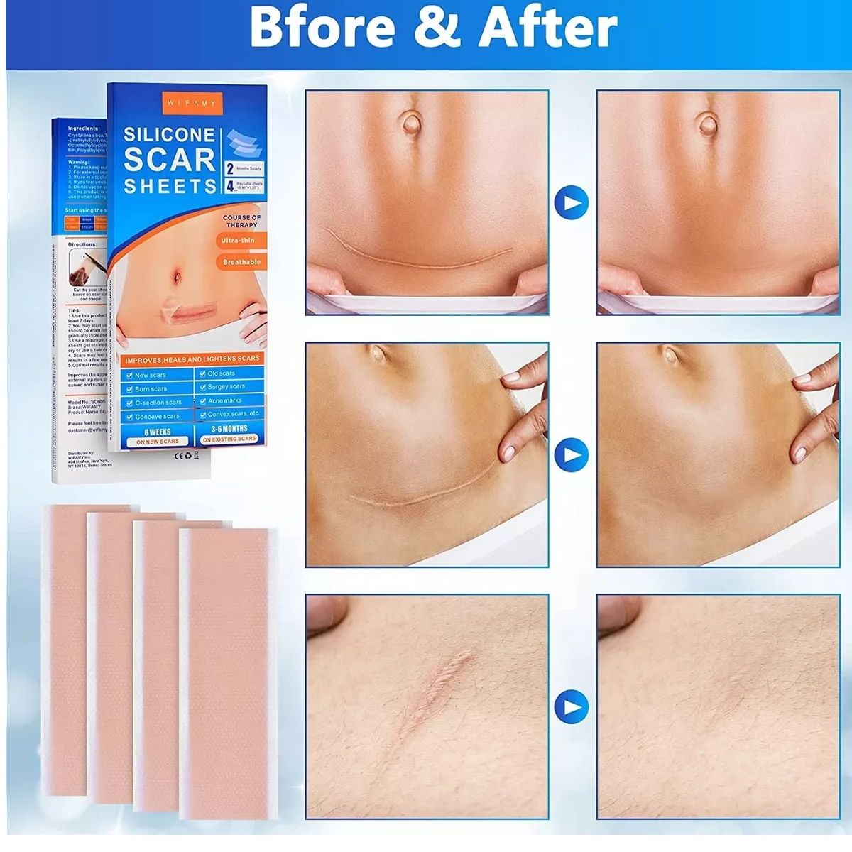 GENERICO - Parche Para Cicatrices Queloides Gel Heridas 2 Parches 15cm