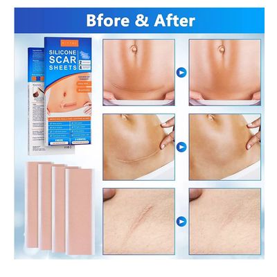Imagen 2 del producto Parche Para Cicatrices Queloides Gel Heridas 2 Parches 15cm