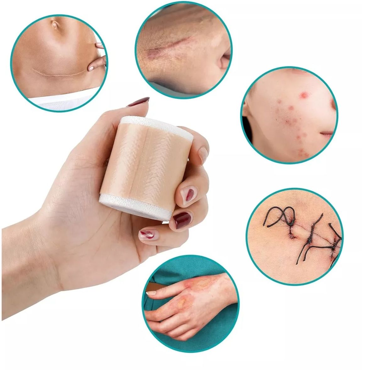 GENERICO - Parche Para Cicatrices Queloides Gel Rollo De 4cmx1m Heridas