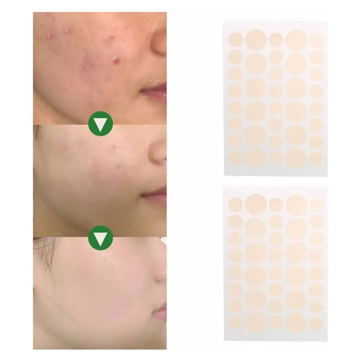 FLAMENCO - Parches Anti - Acné Ultra Delgados