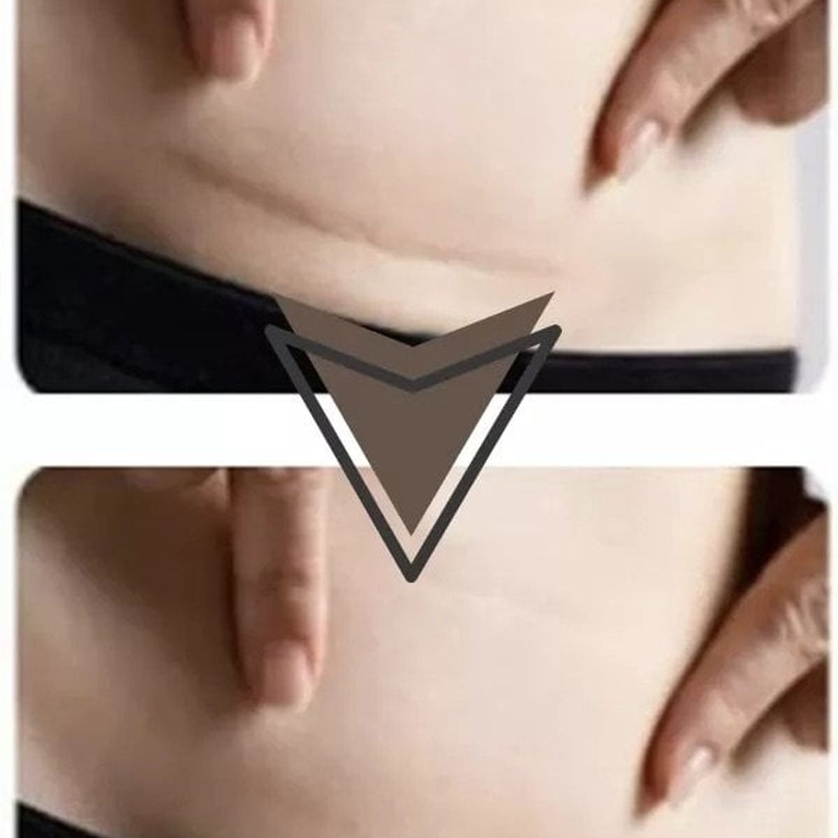 RECOVERY - Parche Silicona Cesarea Queloide Cicatriz Recovery  Scar Tape 4cmx15mt Color Beige