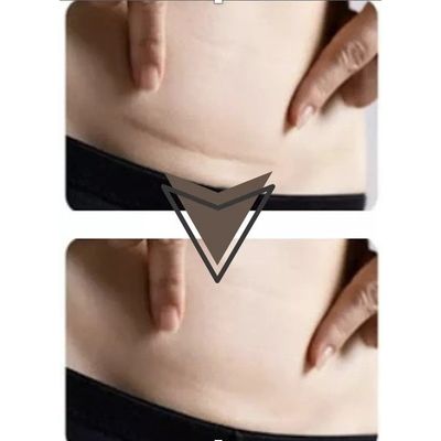 Imagen 2 del producto Parche Silicona Cesarea Queloide Cicatriz Scar Tape 4cmx15mt Color Beige