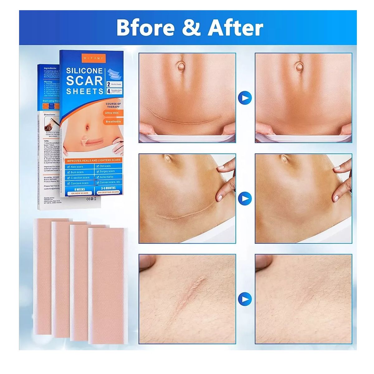 GENERICO - Parche Para Cicatrices Queloides Gel Heridas 2 Parches 15cm