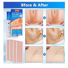 GENERICO - Parche Para Cicatrices Queloides Gel Heridas 2 Parches 15cm