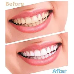 MOVI - BLANQUEADOR DENTAL LUMA SMILE