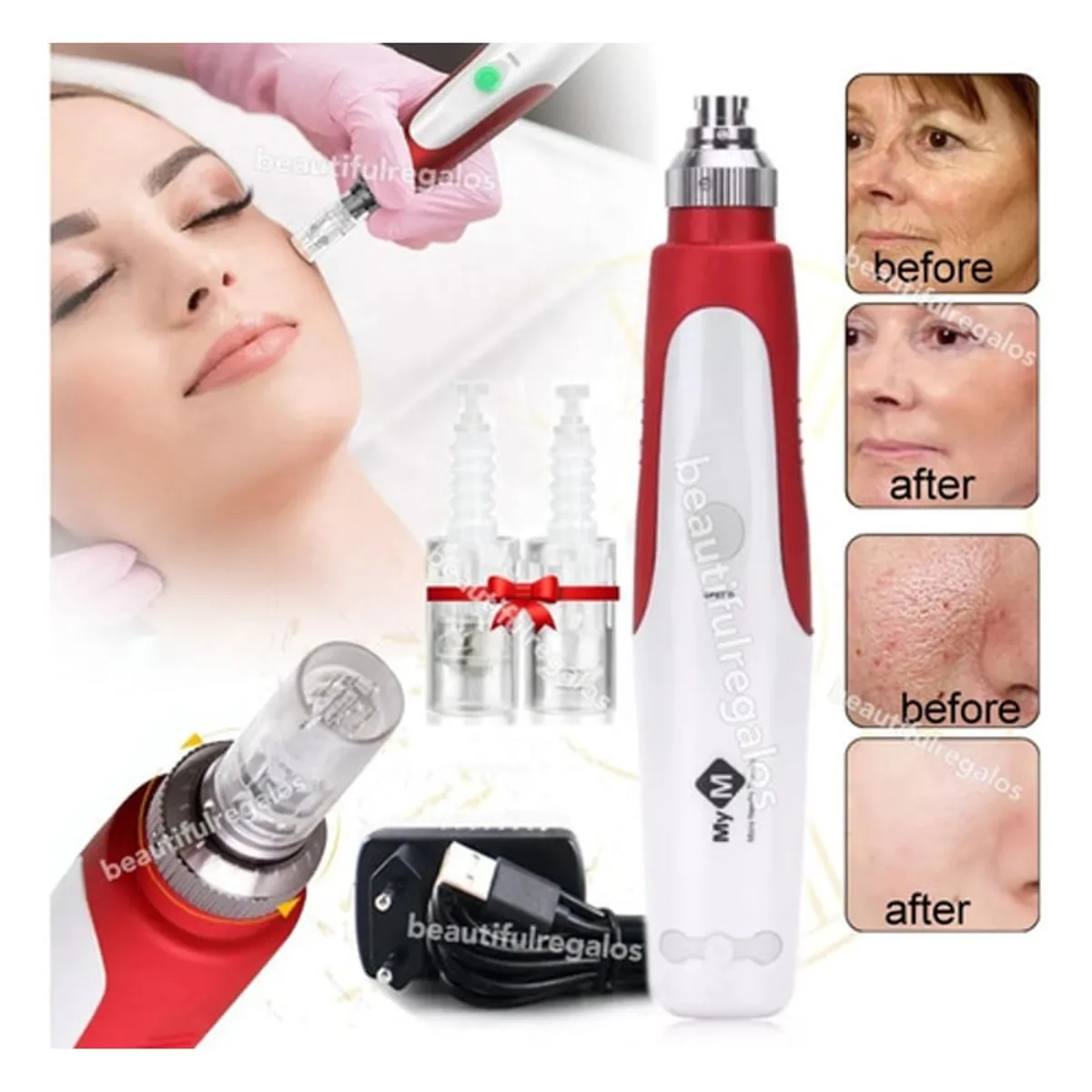 MOVI - Dermapen Facial MyM con 5 Velocidades y 2 Repuestos
