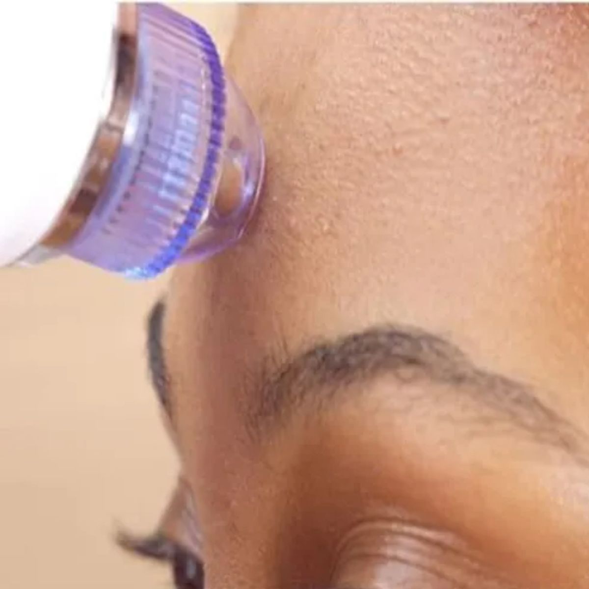 GENERICO - Máquina Succionadora De Puntos Negros Y Acné