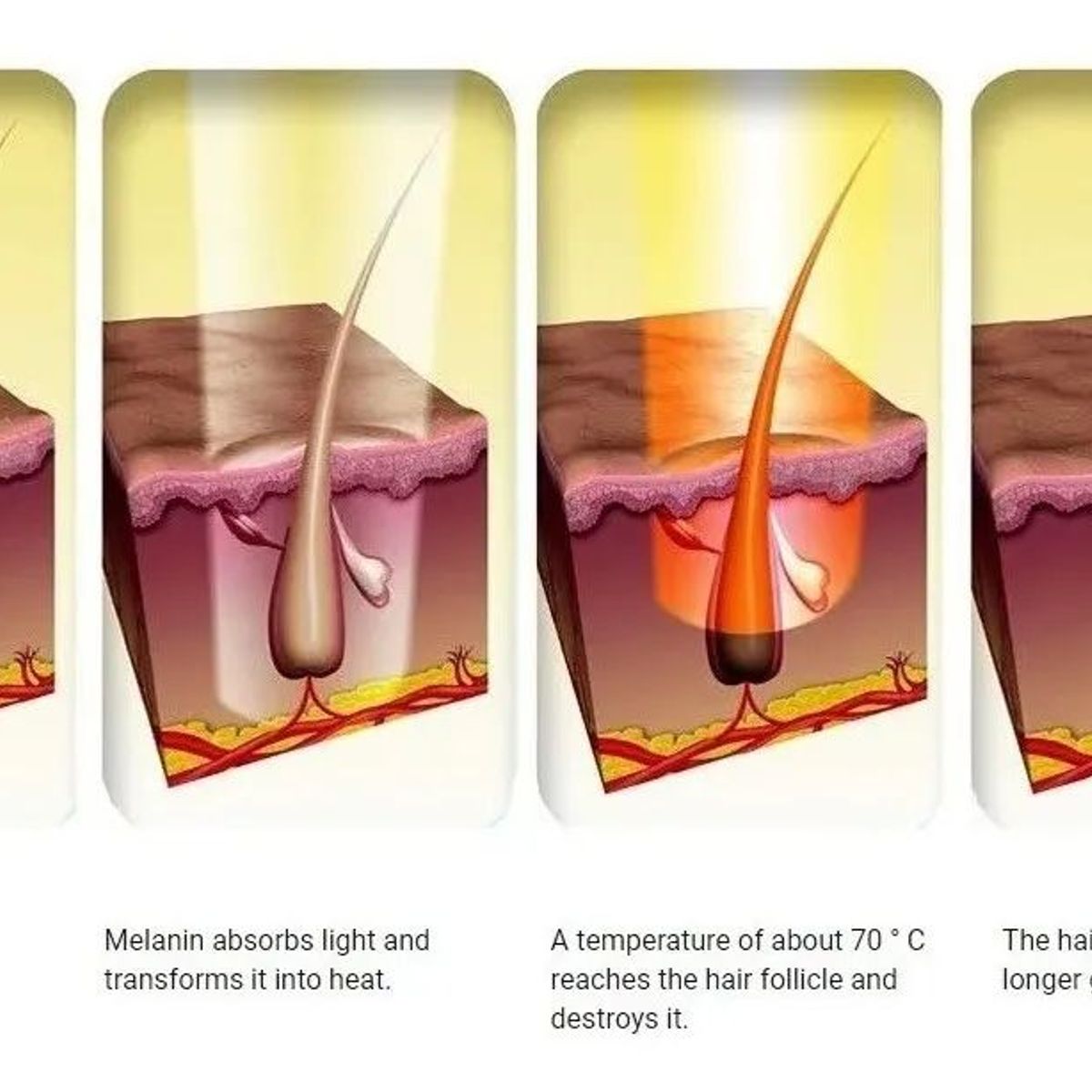 MOVI - Máquina Depiladora Laser Definitiva 3 En 1 Acné Anti Edad