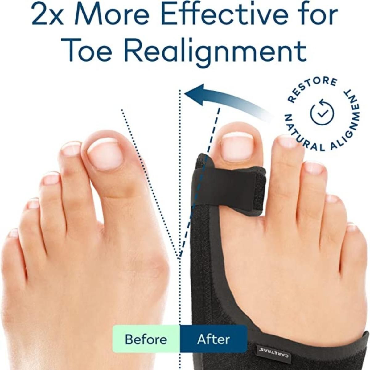 GENERICO - Pack de 2 Pares de Férulas para Corrección de Juanetes