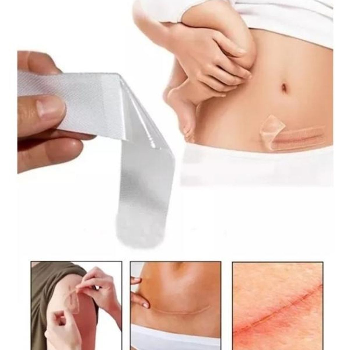 GENERICO - Parche de Silicona Médica para Cicatrices Hipertróficas y Queloides
