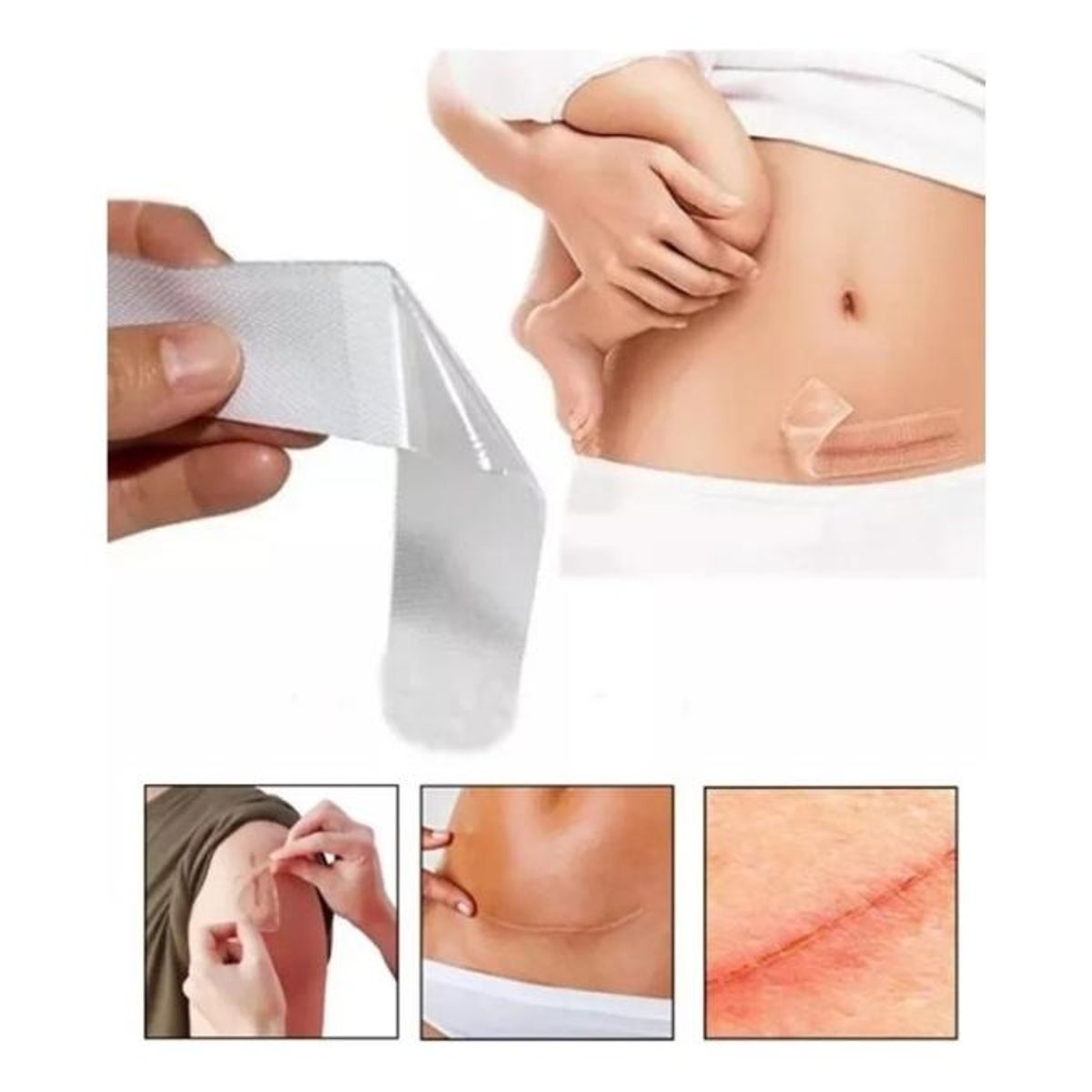 GENERICO - Parche de Silicona Médica para Cicatrices Hipertróficas y Queloides