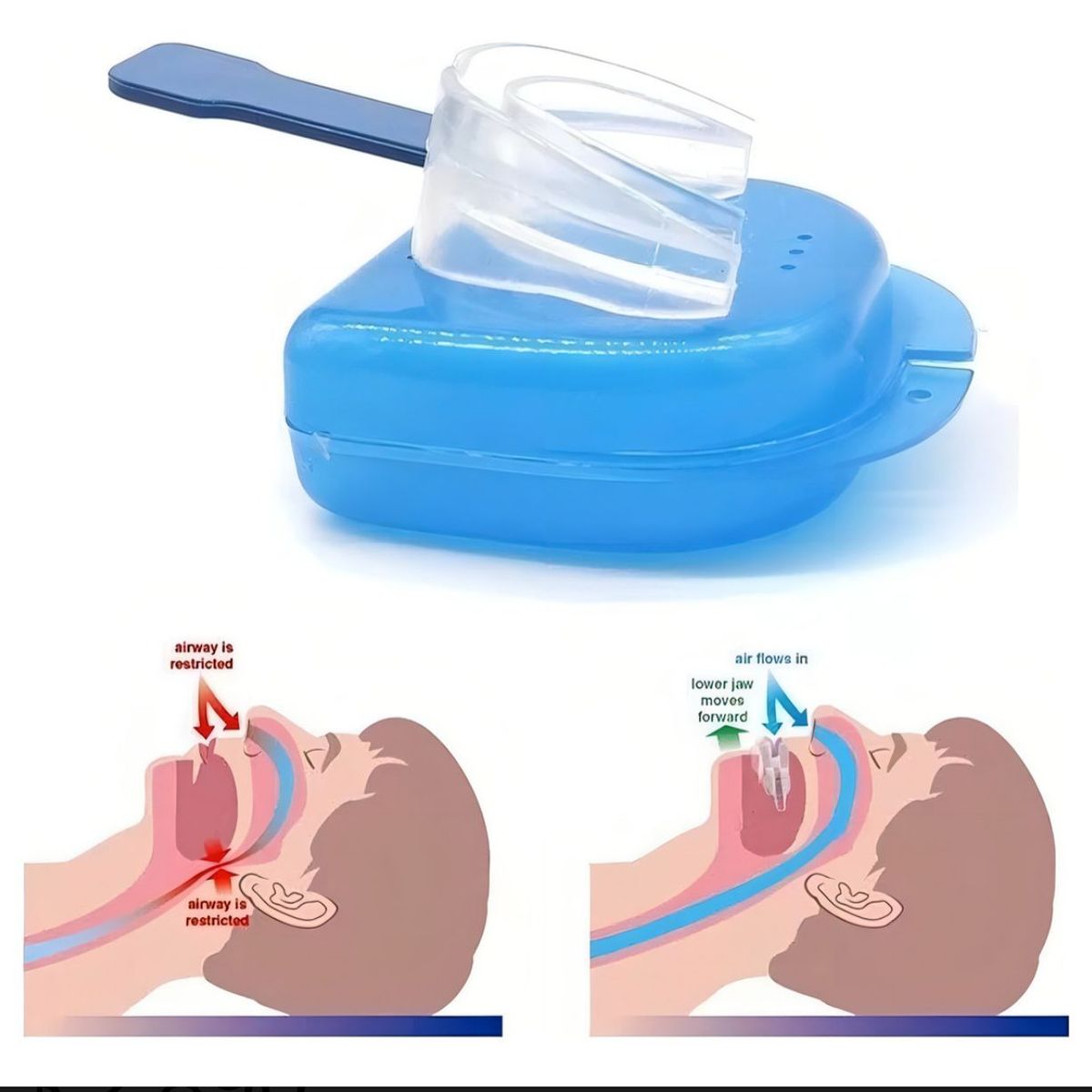 GENERICO - Placa Antibruxismo Anti Apnea Y Antirronquidos Con Estuche
