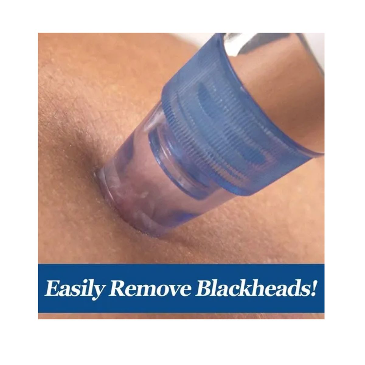 GENERICO - Limpiador Facial Electrico Extractor Espinillas Exfoliador