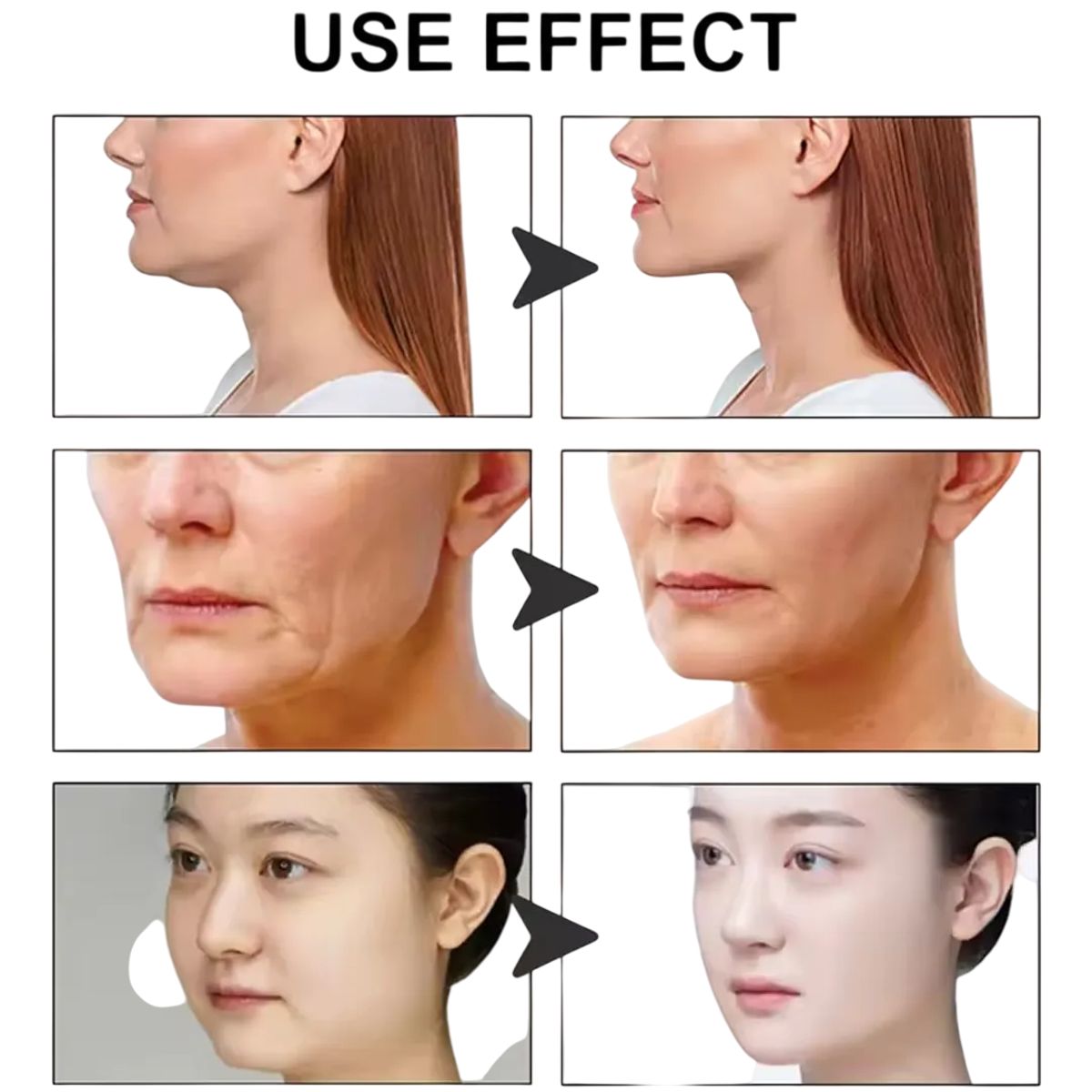 GENERICO - Parches Levantamiento Facial Barbilla