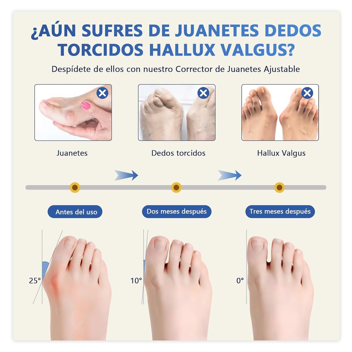 KUANGYE - Kit 11 Correctores Juanete Y Protectores,separador Dedos Pie