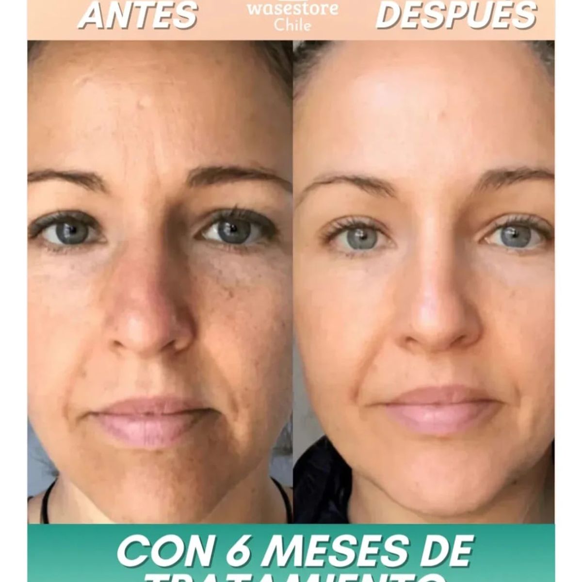 GENERICO - Parches Nanosolubles De Colageno  Rostro 5 Unidades