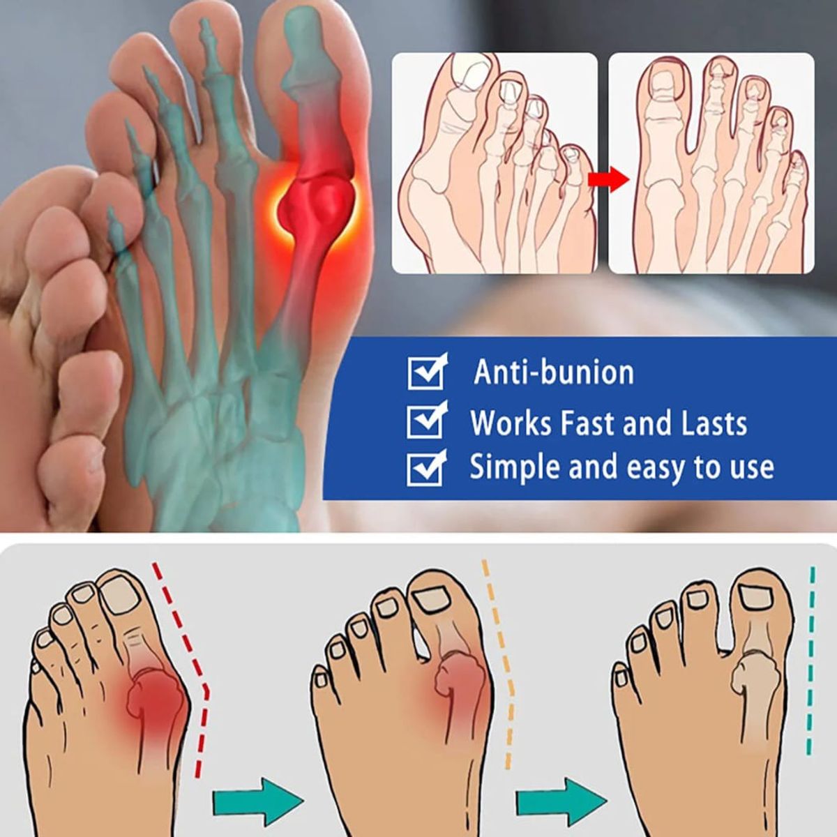 GENERICO - Parches Adhesivos para Alivio del Dolor de Juanetes