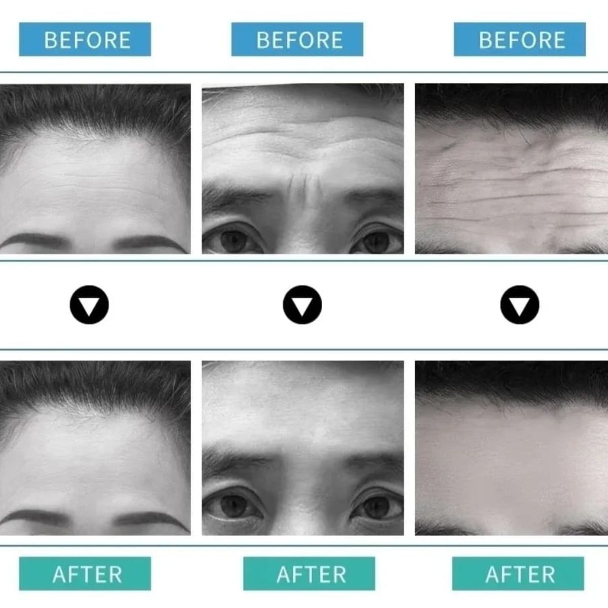 GENERICO - Parches Para La Frente  Alisadores De Arrugas 10pcs