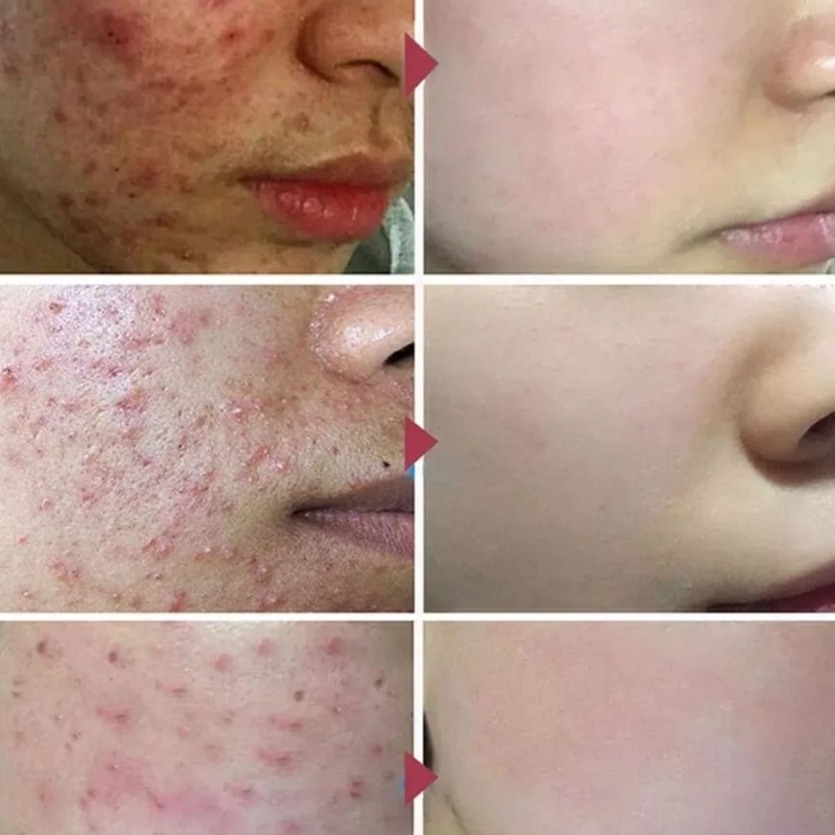 GENERICO - Aceite de Árbol de Té Multiusos para la PielTea Tree Oil