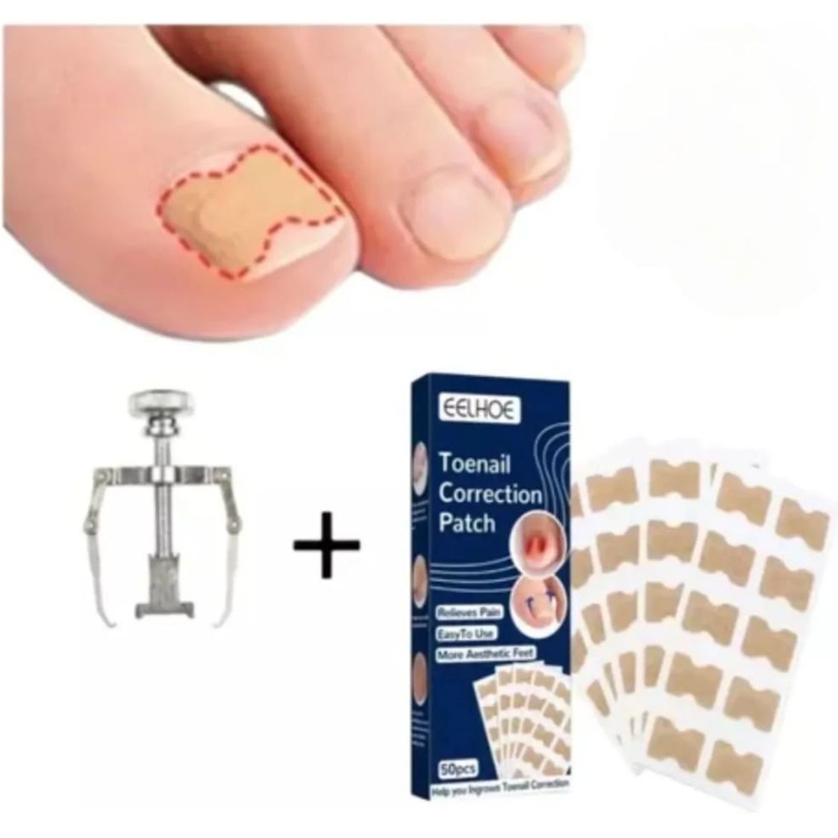 GENERICO - Kit de Corrección de Uñas Encarnadas