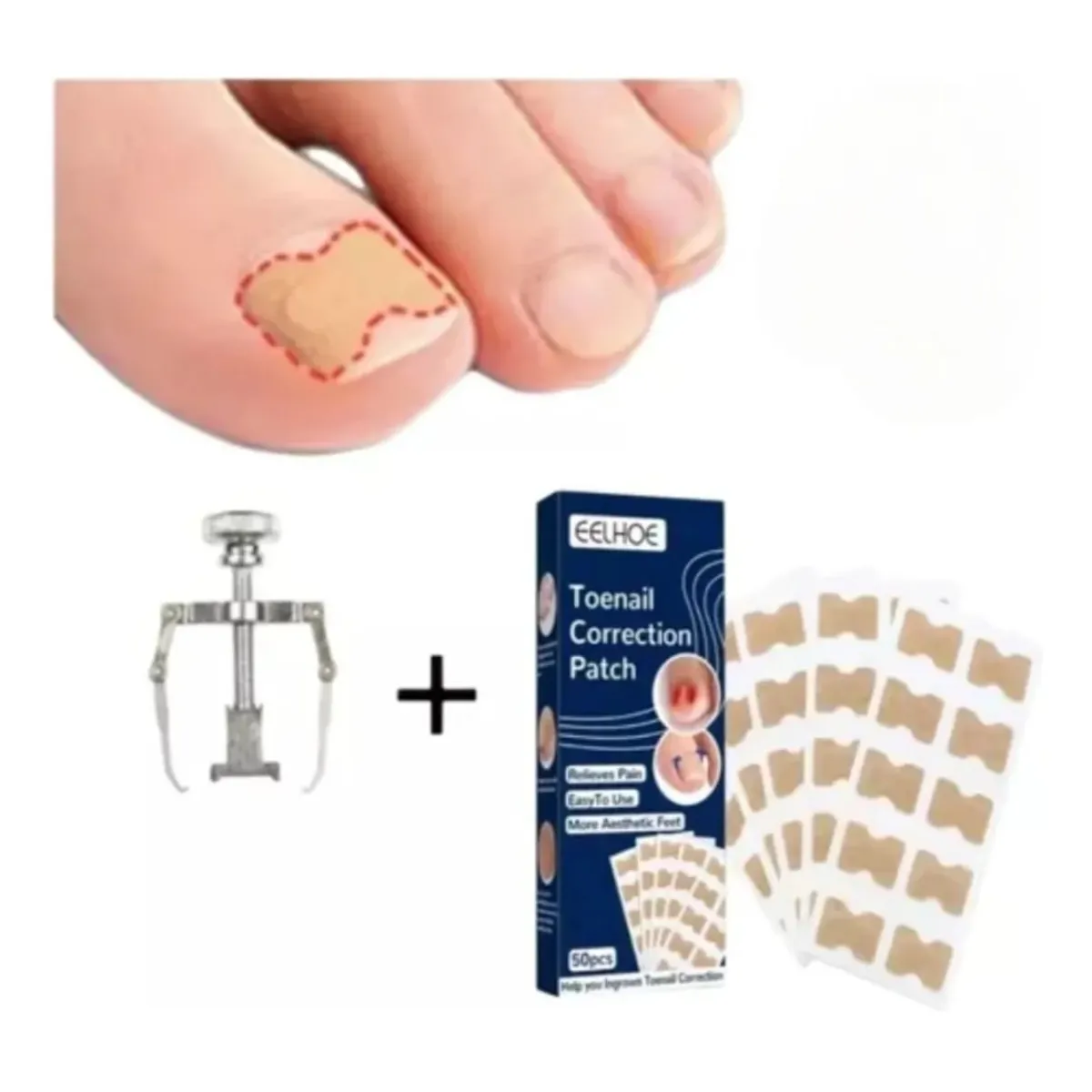 GENERICO - Kit de Corrección de Uñas Encarnadas