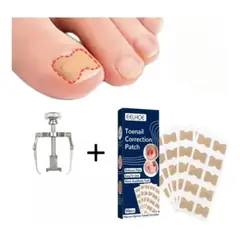 GENERICO - Kit de Corrección de Uñas Encarnadas