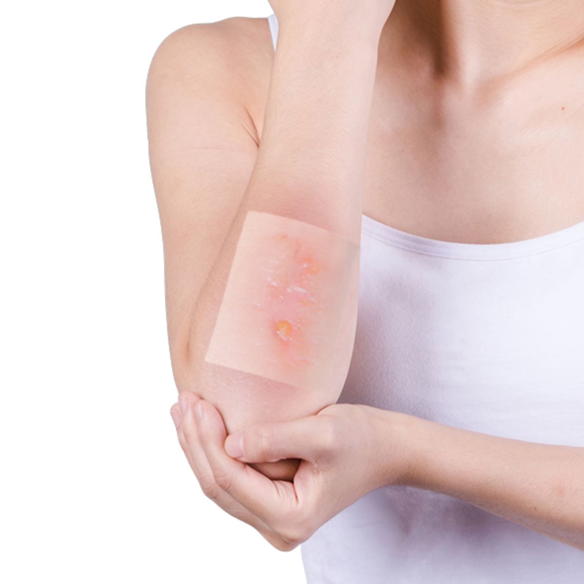 RECOVERY - Rollo Hidrocoloide Cuidado Heridas, Ampollas, Acné 5cm x 1,5 mt