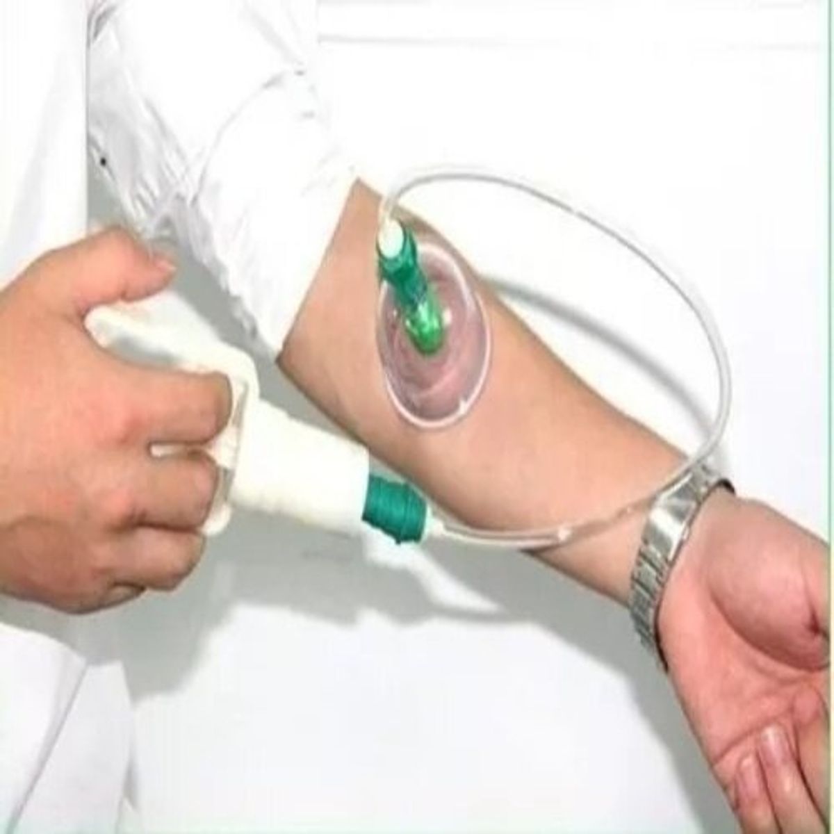 GENERICO - Kit 6 Ventosas Terapéuticas Masajes Acupuntura Y Desintoxica