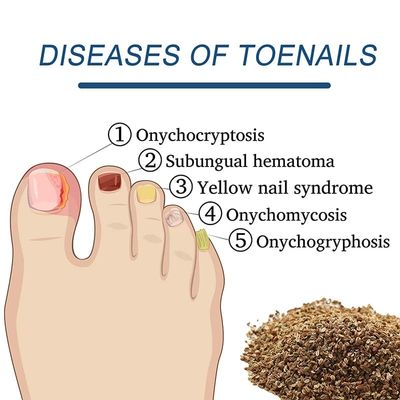 Imagen 2 del producto Parches Antihongos Para El Cuidado De Las Uñas 16 Unidades