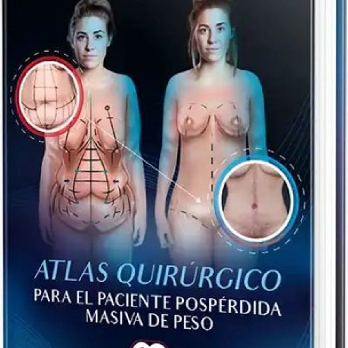 GENERICO - Libro Atlas quirúrgico para el paciente pospérdida masiva de peso
