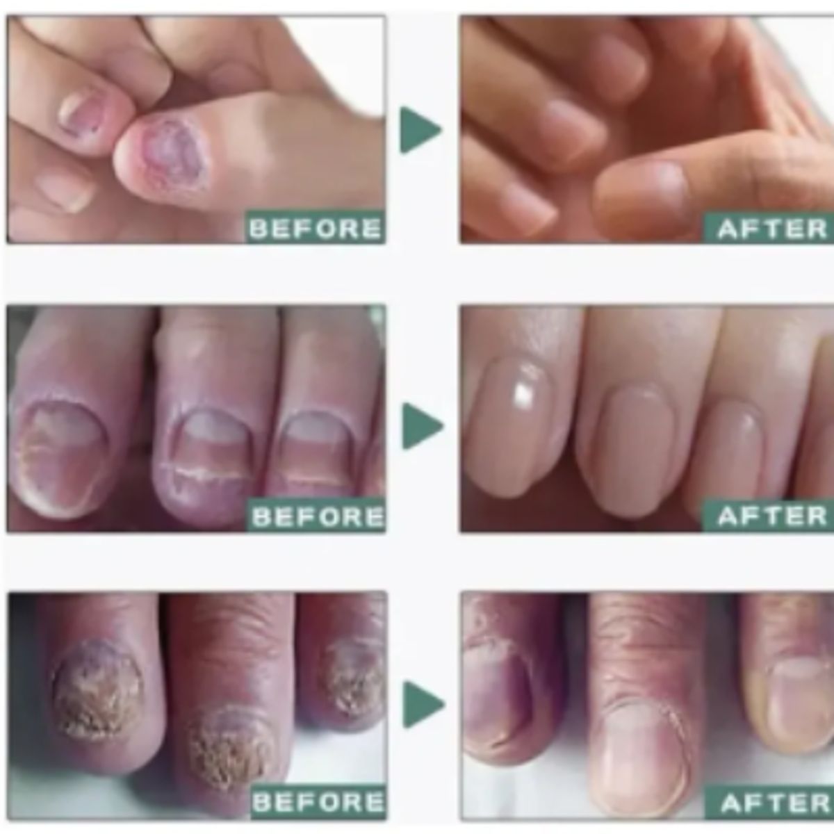 GENERICO - Gotas Tratamiento Anti Hongos Uñas Onicomicosis Pies 10ml