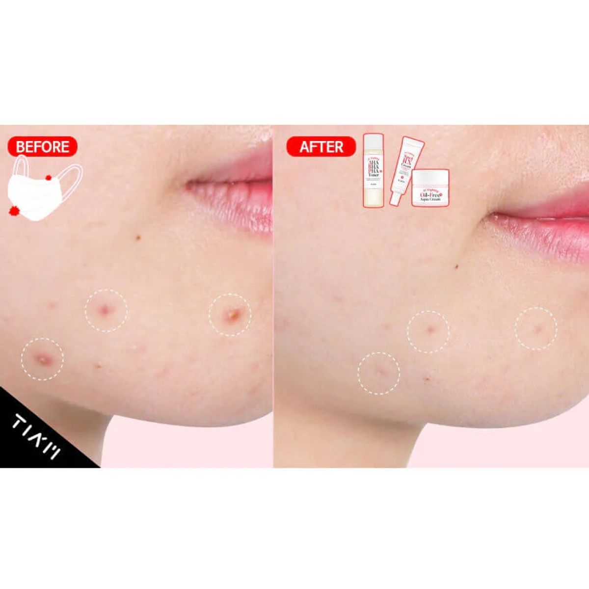 TIAM - AC Fighting Spot Rx Cream