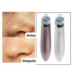 MOVI - Removedor extractor de Puntos Negros e Impurezas
